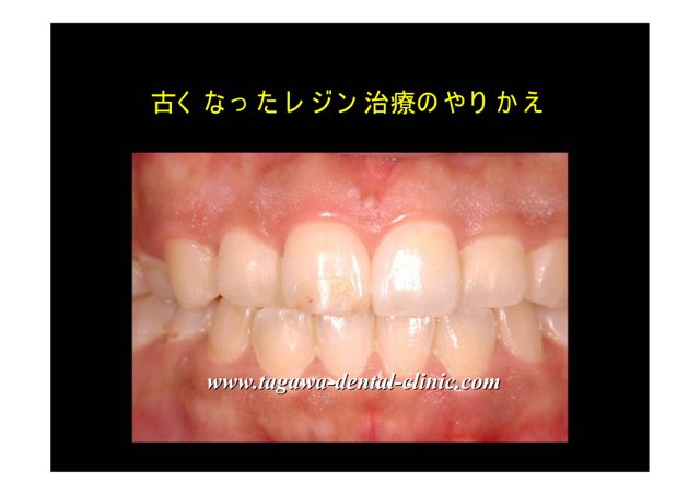 前歯のレジン変色の初診時写真